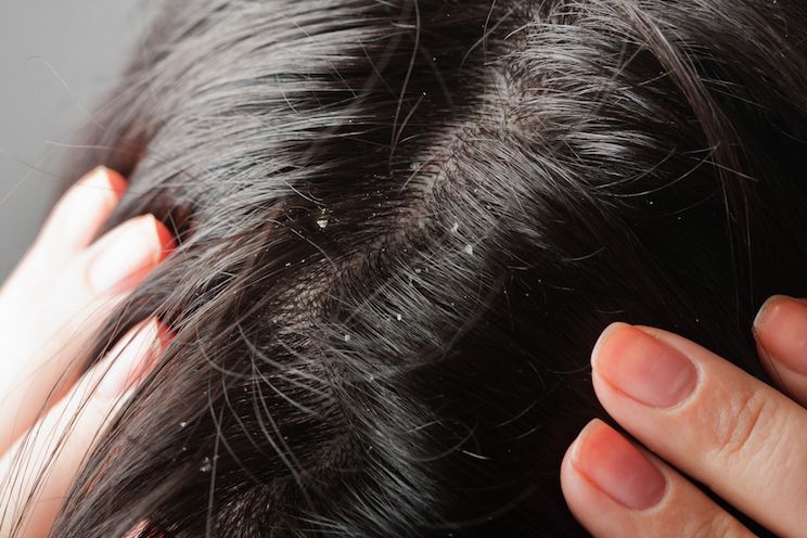 home remedies for dry hair from autoimmune disease