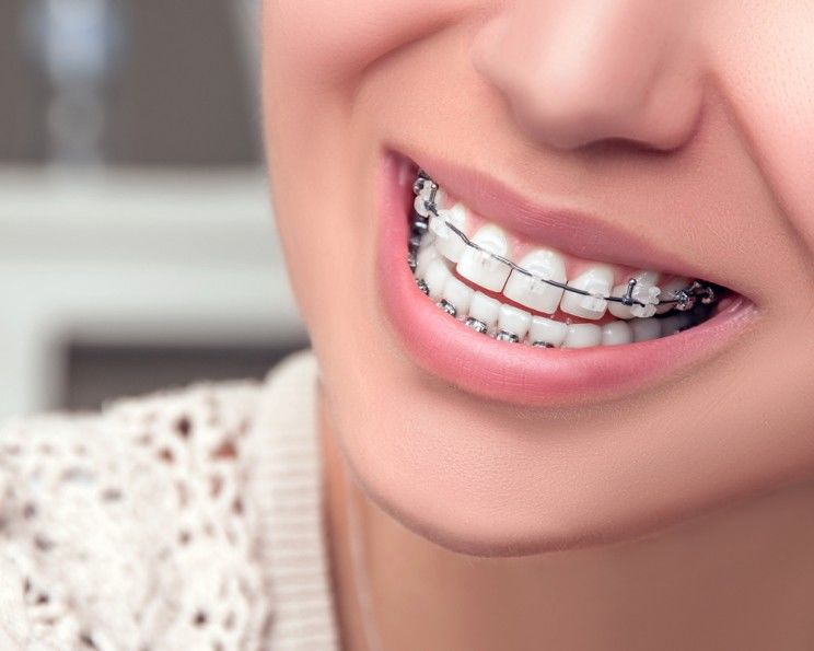 braces dental