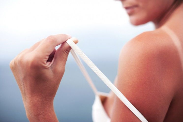 woman with sunburn on her shoulders