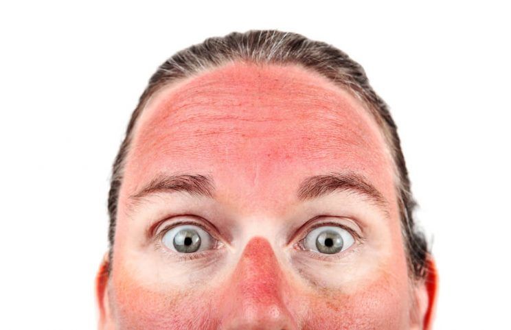 Woman with sunburn