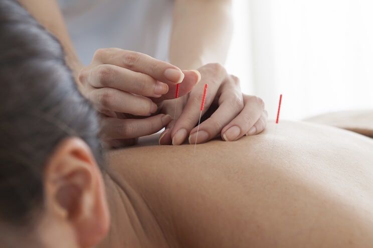 woman getting acupuncture