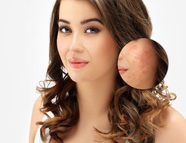 acne scars featured image
