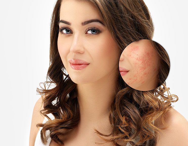 acne scars featured image