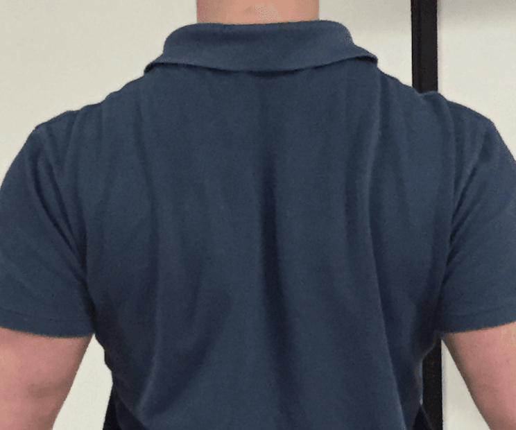 scapular squeezes for tennis elbow