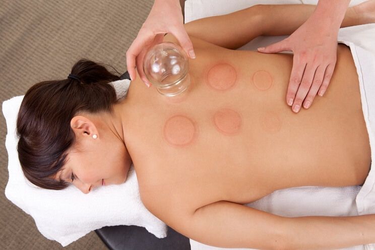 red welts on a woman getting cupping therapy