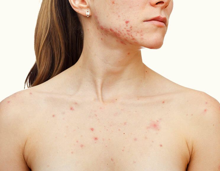foods that cause acne featured image