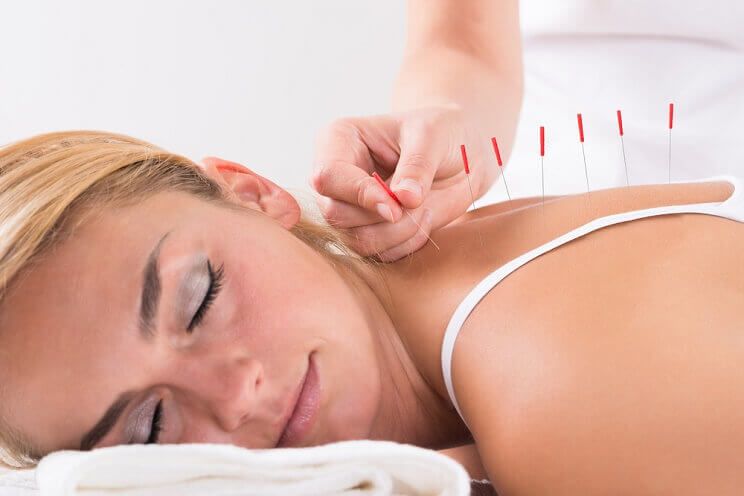 woman getting acupuncture