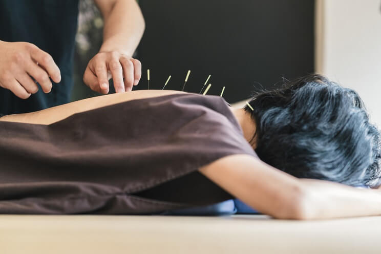 woman receiving acupuncture