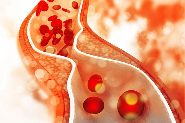Understanding the Different Types of Cholesterol