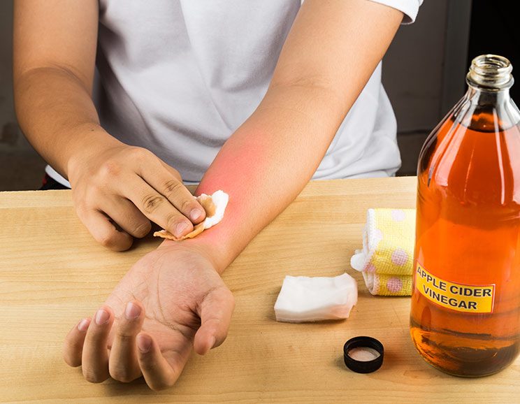 Skip The Harmful Ice Pack - 12 Home Remedies for Burns To Try Instead