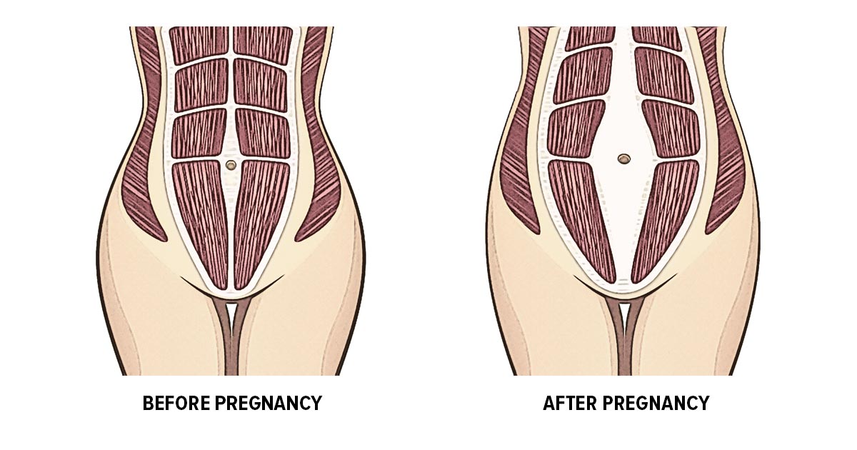 Как выглядит диастаз живота у женщины фото